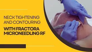 Neck Tightening and Contouring with Fractora Microneedling RF