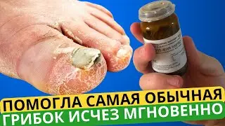 Эта ЯДРЁНАЯ Советская Мазь Разъест Весь Грибок с Ногтей! Лучше Любой Аптеке!