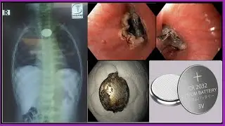 Pediatric Foreign Body Removal Of Lithium Coin Cell Battery l ফরেন বডি রিমুভাল #BD_ENDOSCOPY