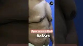Gynecomastia Before and  After Result #gynecomastiaresult #shorts #sbaesthetics #beforeandafter