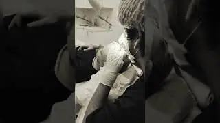 Пересадка волос