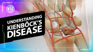 Kienböck’s Disease: When a Wrist Bone Starts to Die