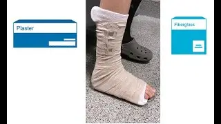 Splinting with fiberglass versus plaster