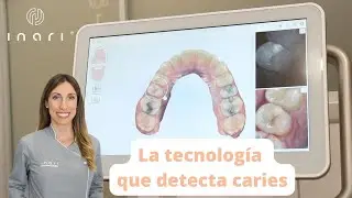 Detecta las caries - Tecnología NIRI