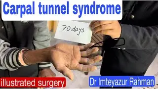 Carpal tunnel syndrome, volksman ischemia, wrist Injury & fracture.