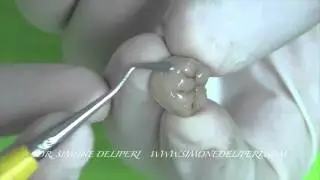 Fiber-reinforced Semidirect Composite Resin Restorations - Dr. Simone Deliperi