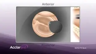 Tympanostomy tube delivery system