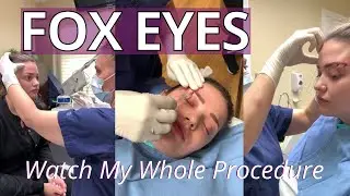 Watch My Foxy Eyes Thread Lift [ See the Whole Thing Start to Finish ]