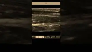 2   Clot forming around catheter