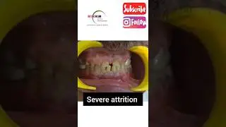 Teeth Attrition Smile Makeover in 7 days #smile #smilemakeover #dentist