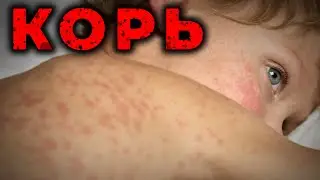 Корь. Диагностика и лечение на этапе Скорой помощи. #ПроСМП