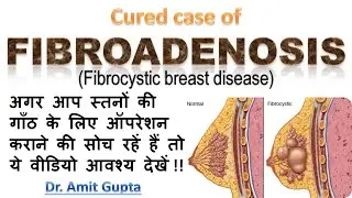 Fibroadenosis cured case