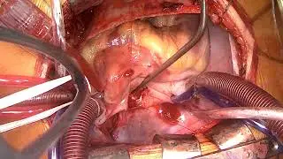 Conventional Repair of Supracardiac Total Anomalous Pulmonary Venous Connection