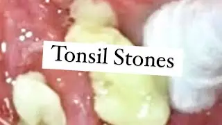 Biggest Tonsil Stones! Do I Need My Tonsils Removed 👍👍👍👍