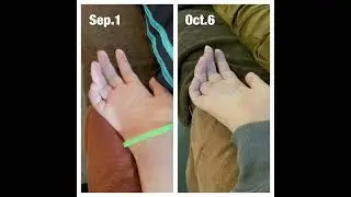 ALS symptom improvement in a month