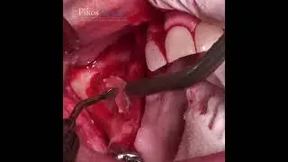 Sinus Graft Window Outline in 3 Easy Steps