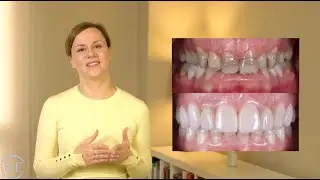 CARILLAS DENTALES: ¿qué hace que se vean naturales?