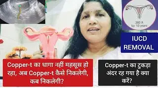 Copper-t कैसे निकलेगी?  धागा महसूस नहीं हो रहा या Copper-t का टुकड़ा अंदर रह गया है? IUCD REMOVAL