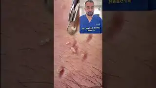 Dr Khaled Sadek reacts #blackheads skincare to