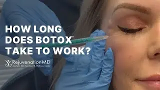 Botox for Crow’s Feet and 11s
