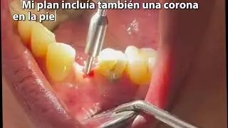 SIN TRAMPA NI CARTON..!! CON IMPLANTES BASALES E HIBRIDOS