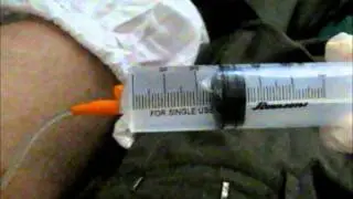 BCG Instillation In Urinary Bladder