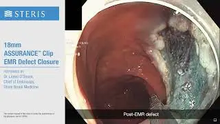 EMR Defect Closure using the 18mm ASSURANCE™ Clip | STERIS
