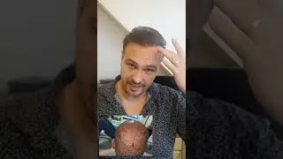 Haartransplantation  OP