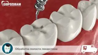 Лечение кариеса зубов
