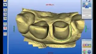 Cerec Veneers  by Daniel Vasquez DDS