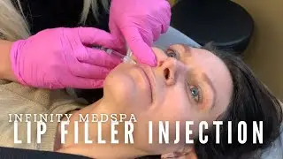 Lip Filler Injection | Infinity MedSpa