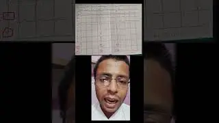 comment when to treat premature ventricular complexes (PVC)?#shorts