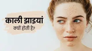 चेहरे की झाई || remove pigmentation || remedy of melasma || elocon cream || Freckles face || Jhaiya