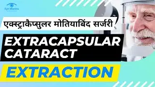 एक्स्ट्राकैप्सुलर मोतियाबिंद सर्जरी : Extracapsular Cataract Extraction