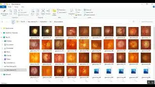 Short Analysis of Machine Learning and Deep Learning Techniques used for Glaucoma Detection