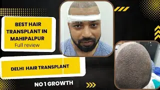 Hairtransplant in Delhi | Hair transplant in mahipalpur|Hair transplant in India| hisar |barely