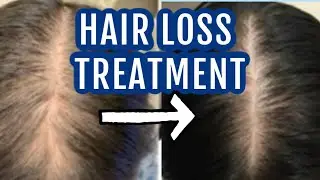 Spironolactone for hair loss| Dr Dray