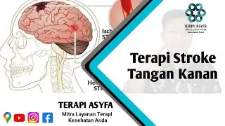 Terapi Stroke Tangan Kanan