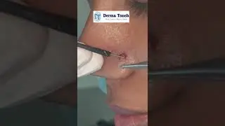 Viral wart on nose of a girl
