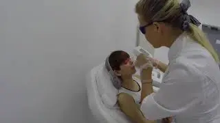 Эпиляция над губой IPLASER