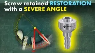 Getting the best out of a poorly placed dental implant using a screw retained restoration
