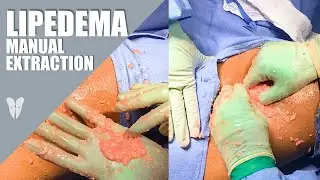 Manual Lipedema Extraction | Dr. Jaime Schwartz | Total Lipedema Care