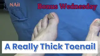 A Really Thick Toenail [Moving the Video Link] (2020)