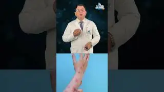 🚨 एम्पॉक्स की गंभीर सच्चाई: लक्षण, कैसे फैलता है और आपकी सुरक्षा! 😷💥 #Mpox #स्वास्थ्यआत्मसुरक्षा