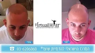 נקודות שיער קצוץ - הדמיית שיער קעקוע שיער נקודות בקרקפת לגברים