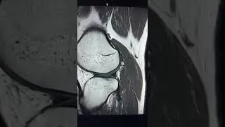 Fabella - Commonly found accessory ossicle
