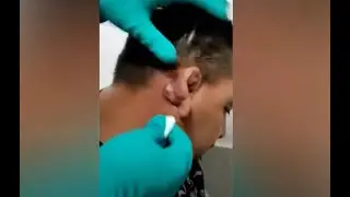 **EAR PIMPLE EXPLODES** | Huge Pimple Popping Compilation (You HAVE to see this clip!)