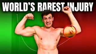 I Experienced World’s Rarest Injury For A Day!