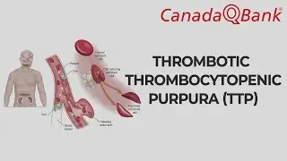Thrombotic Thrombocytopenic Purpura Explained | Pentad, Diagnosis & Treatment | CanadaQBank