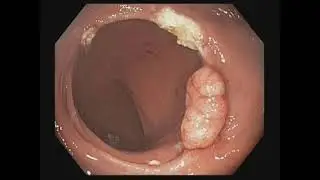 Colonoscopic Polypectomy 